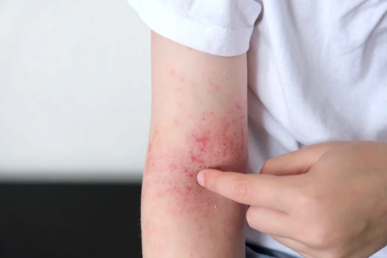 Neurodermitis: Ursachen, Symptome und effektive Behandlung Neurodermitis: Ursachen, Symptome und effektive Behandlung